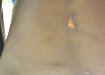 B/R: Stepdad inflicts injuries on his stepson, 11, for leaving school bag outside