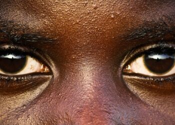 Ghana tops glaucoma cases in Africa – Elijeko CEO