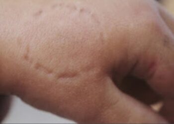 Man bites brother’s finger to death in Oti Region