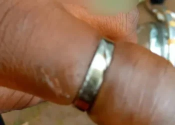 WN/R: Woman nearly lost her finger after wearing her fiancé’s promise ring