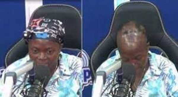 Woman narrates how husband’s side-chick caused her baldness for 3 years