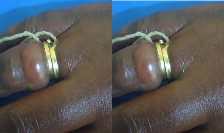 C/R: Woman, 35, cuts her wedding ring due to finger swelling