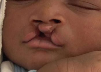 Over 2,000 children benefit from corrective surgeries for cleft lip at KATH