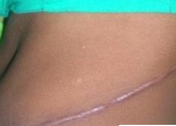 Young woman shares sad story of how her boyfriend harvested her kidney in Dubai