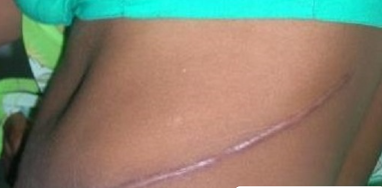 Young woman shares sad story of how her boyfriend harvested her kidney in Dubai