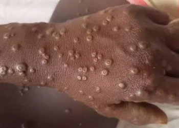 Ghana records first Mpox case, 230 suspected cases under investigation