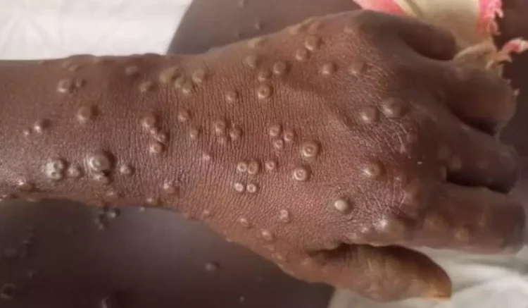 Ghana records first Mpox case, 230 suspected cases under investigation