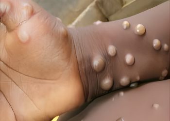 GHS confirms two new cases in Greater Accra and Western Regions