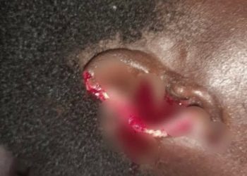 O/R: Husband bites off wife’s ear over domestic dispute in Dambai